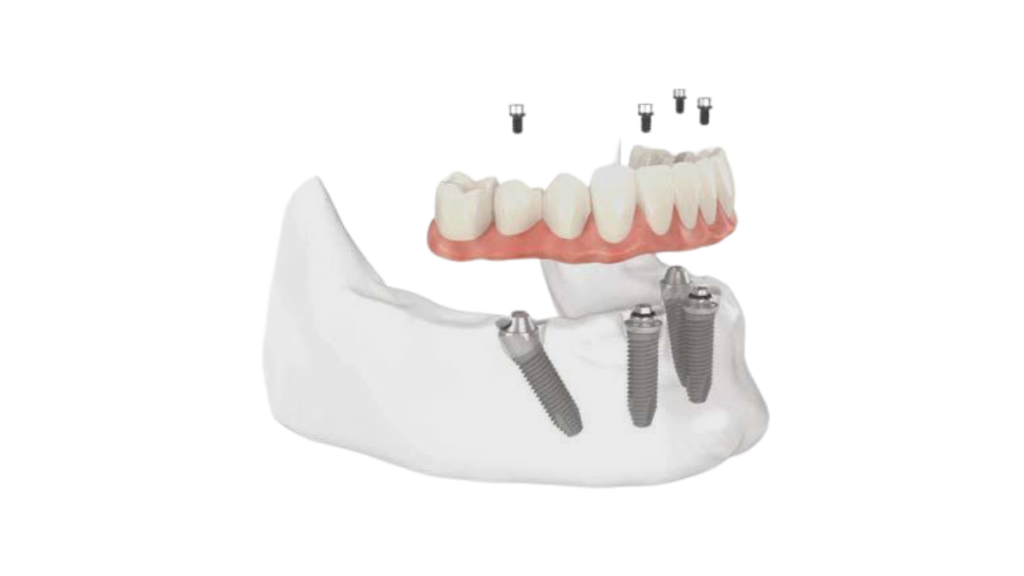 Modelo 3D da Prótese protocolo sobre implante
