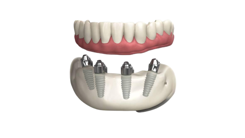 Modelo 3D da Prótese protocolo sobre implante