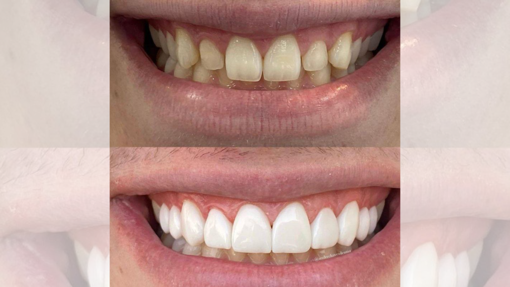 Antes e depois de paciente de lentes de contato