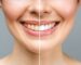Antes e depois de clareamento dental